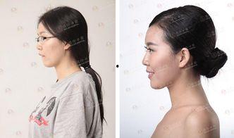 龅牙吃瓜,揭秘牙齿矫正与美食生活的完美融合